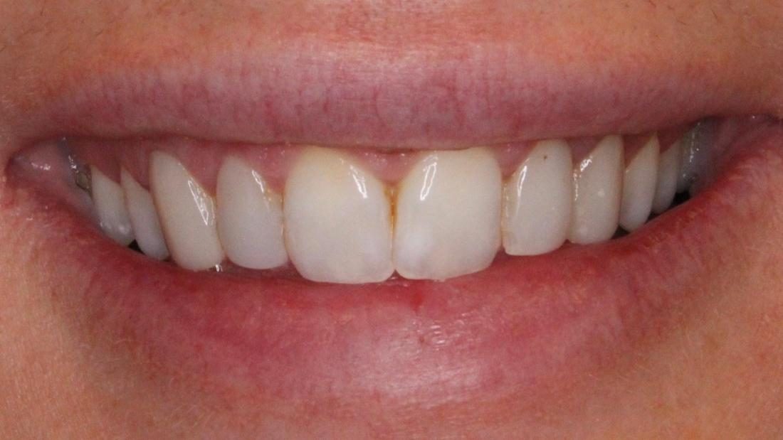 Before crowns and veneers