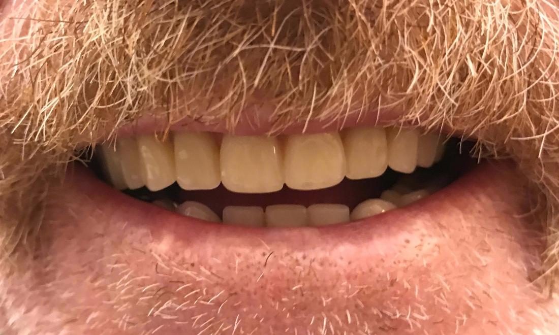 After full dentures