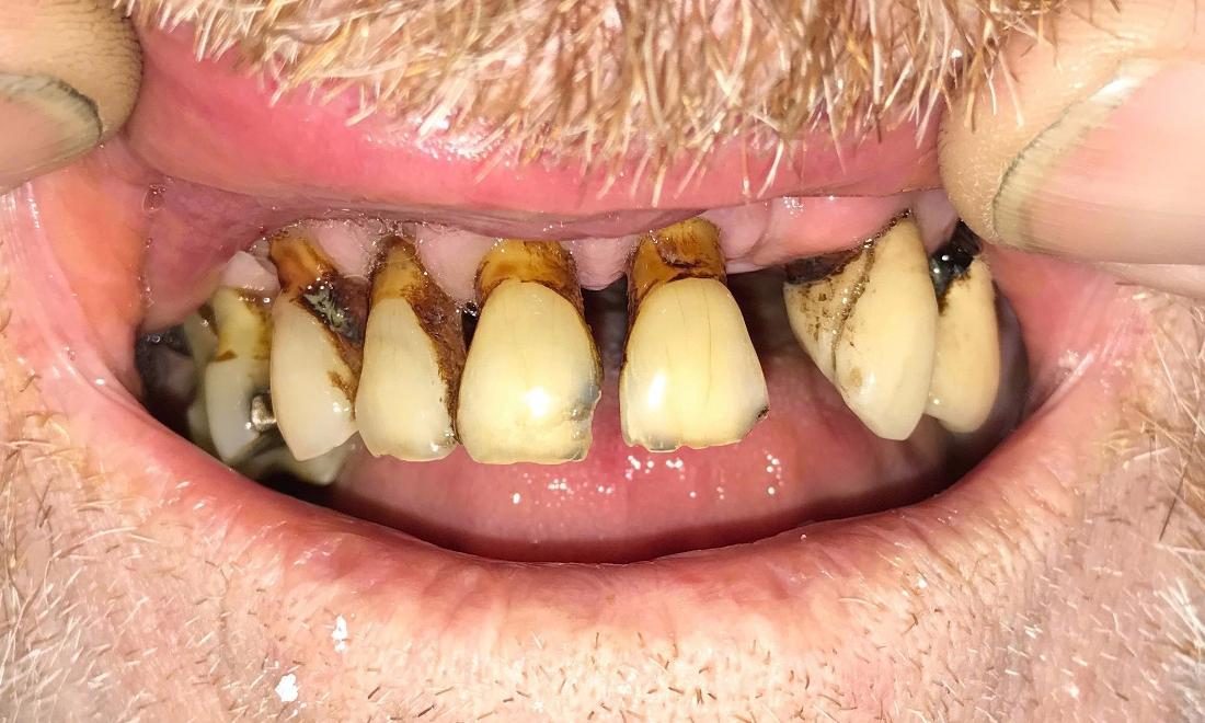 Before full dentures