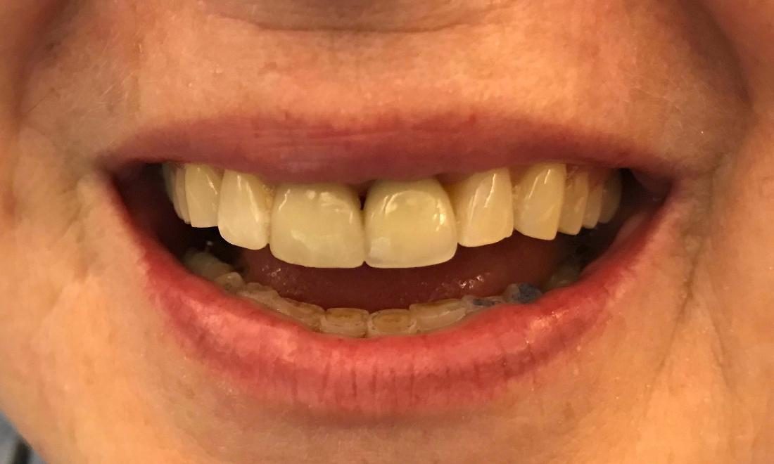 After implant restoration