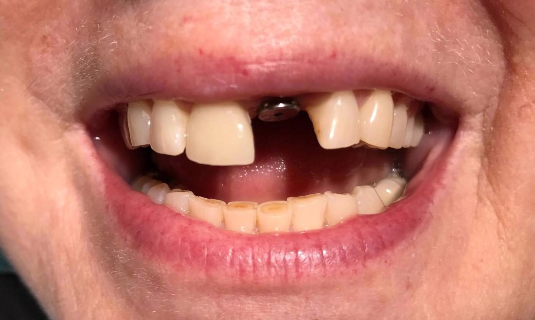 Before implant restoration