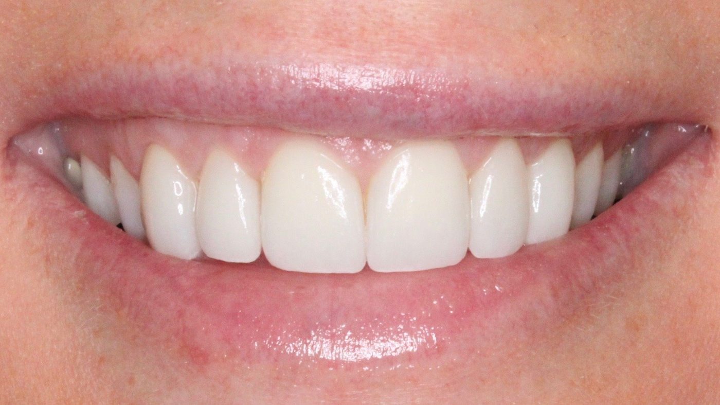 After — porcelain veneers, close up