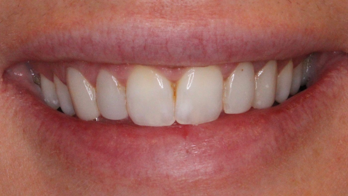 Before — porcelain veneers, close up